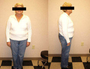 before hcg weight loss woman rock hill and charlotte