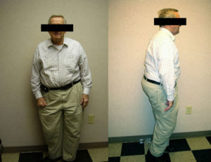 before hcg weight loss man rock hill and charlotte