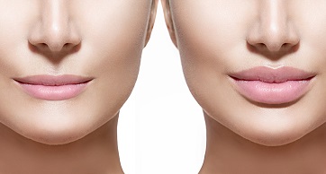 ReJUVenate your lips with Juvéderm®!