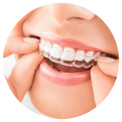SureSmile Aligners