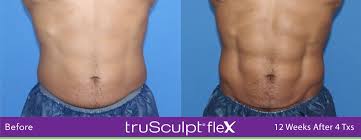 results of trusculpt in rock hill and charlotte