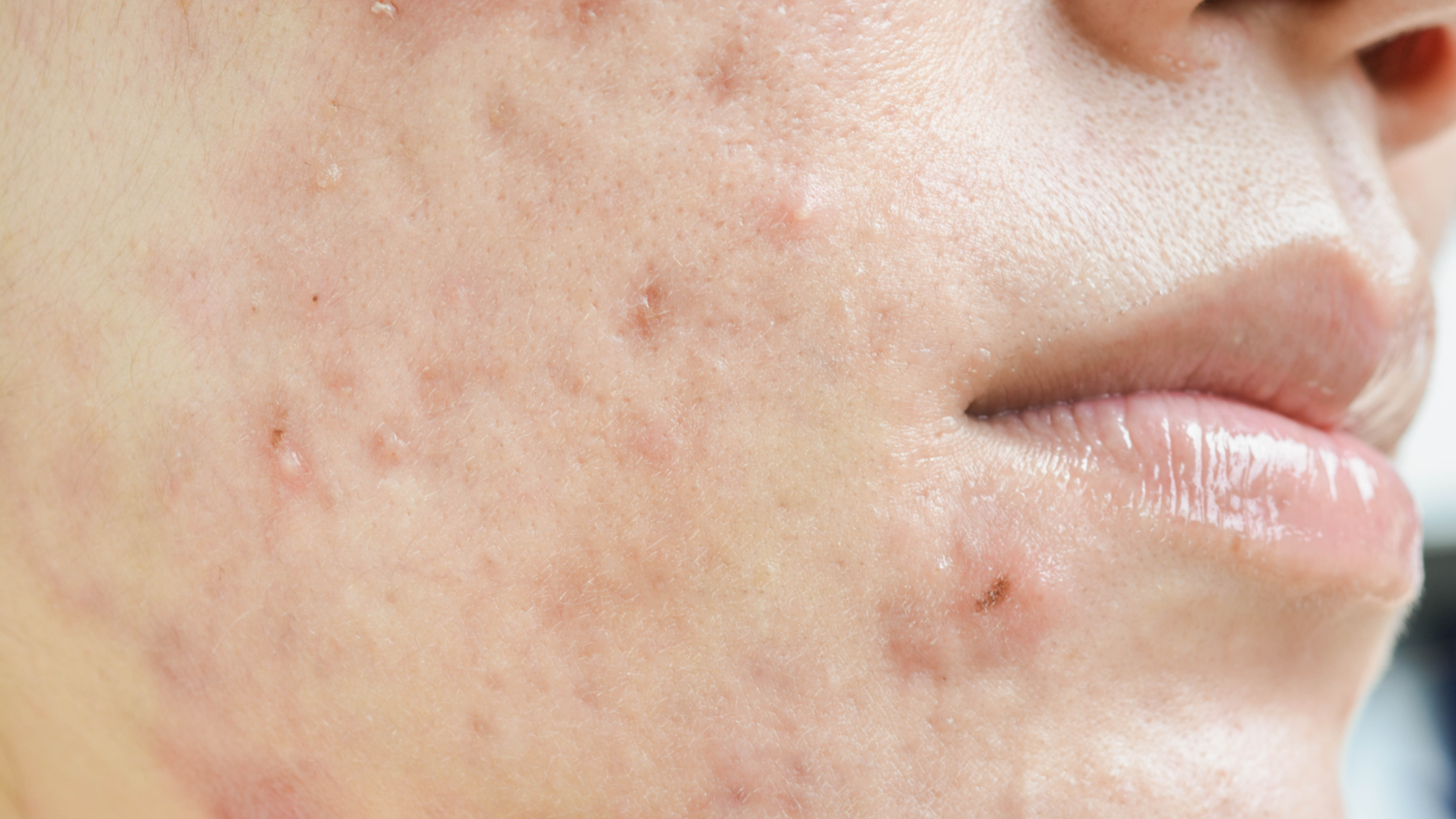 Acne scars