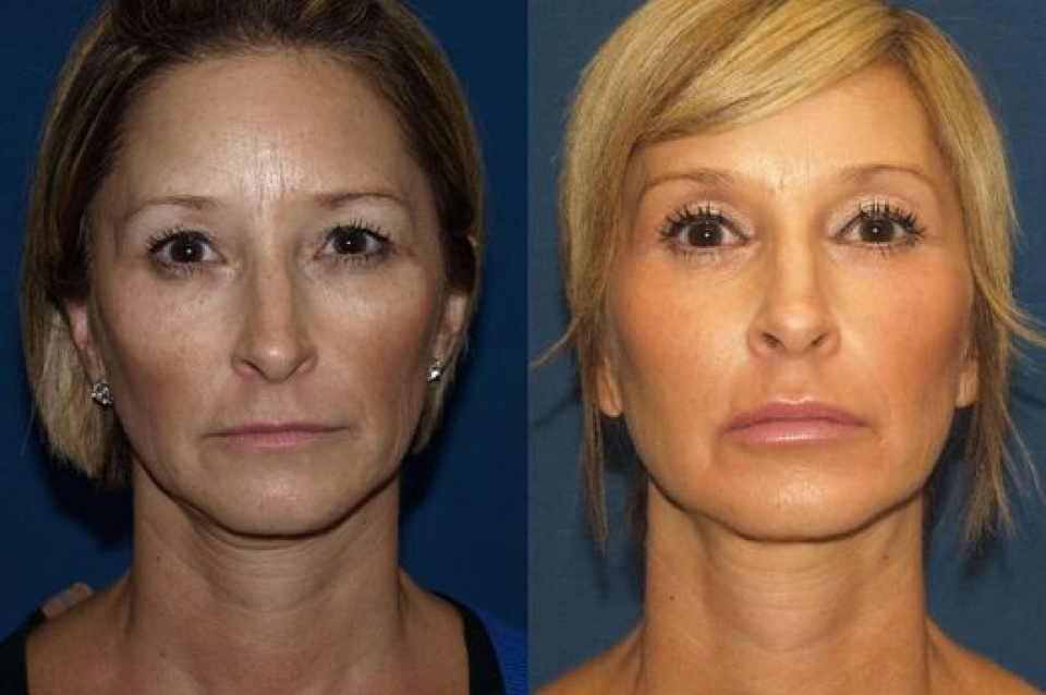 Rock Hill Skin Therapists Share Advanced Treatments To Transform Your Skin in Charlotte & Rock Hill