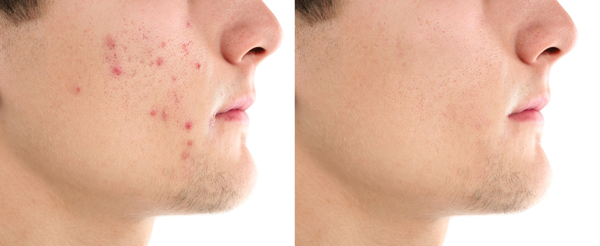 Before and after acne laser treatment