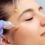 Microneedling treatment in Rock Hill, SC, near Charlotte, York, and Waxhaw.