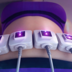 truSculpt ID treatment