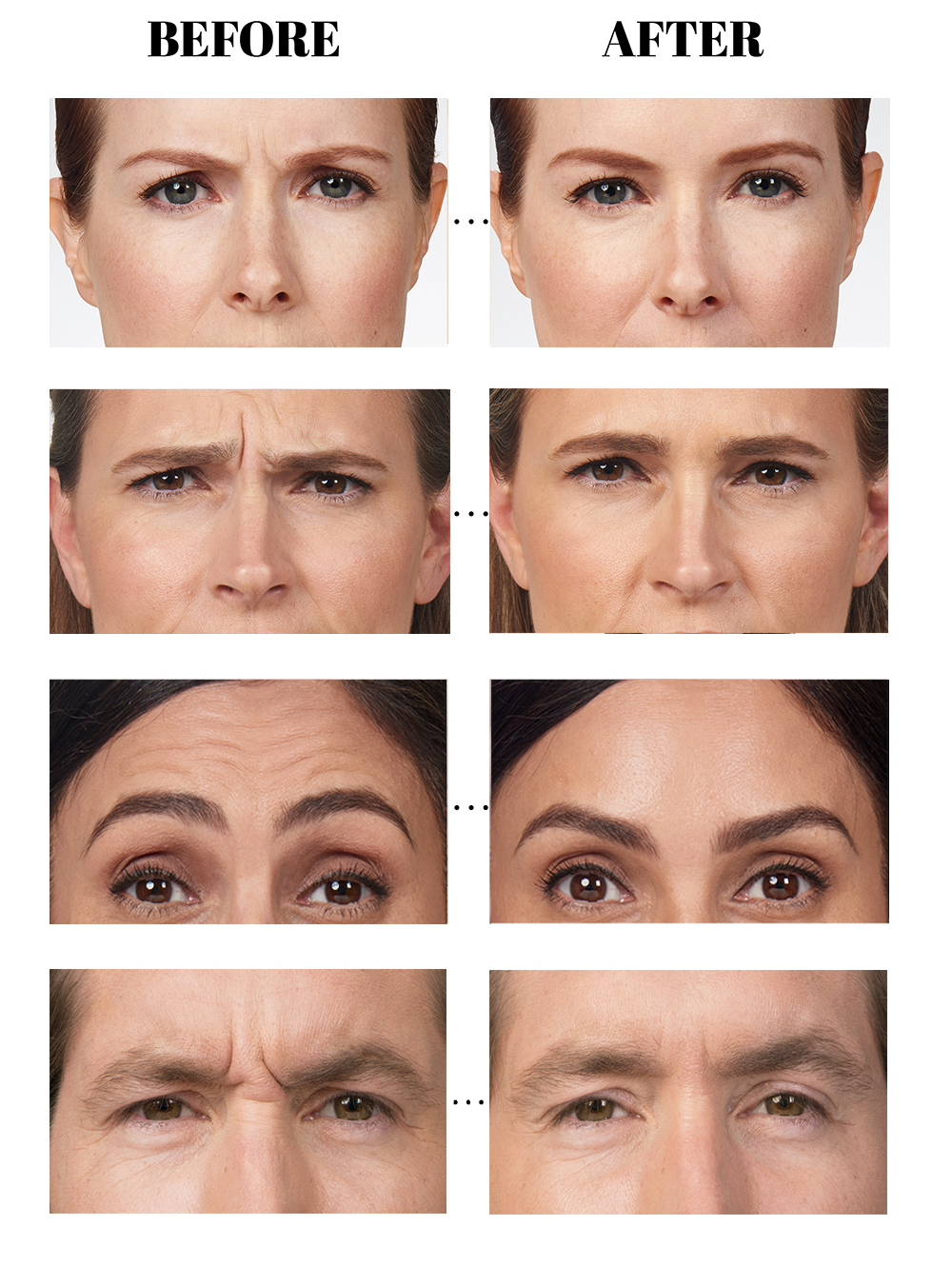 Botox Results at Metrolina Medical Botox Results at Metrolina Medical
