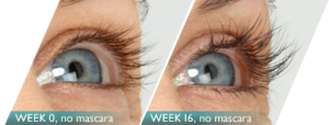 latisse eyelash growth latisse eyelash growth